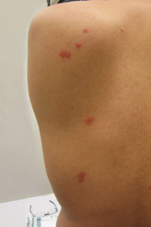 BedBugs infestation 1